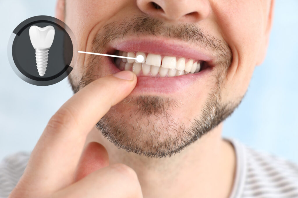 Are Dental Implants Worth It? A Complete Guide for Patients in Marlton, NJ