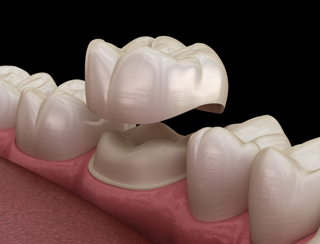 Same-Day CEREC Crowns in San Antonio: Can You Really Get a Dental Crown in One Visit?