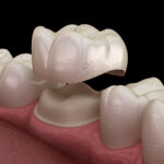 Same-Day CEREC Crowns in San Antonio: Can You Really Get a Dental Crown in One Visit?